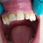Laserska popravka zuba